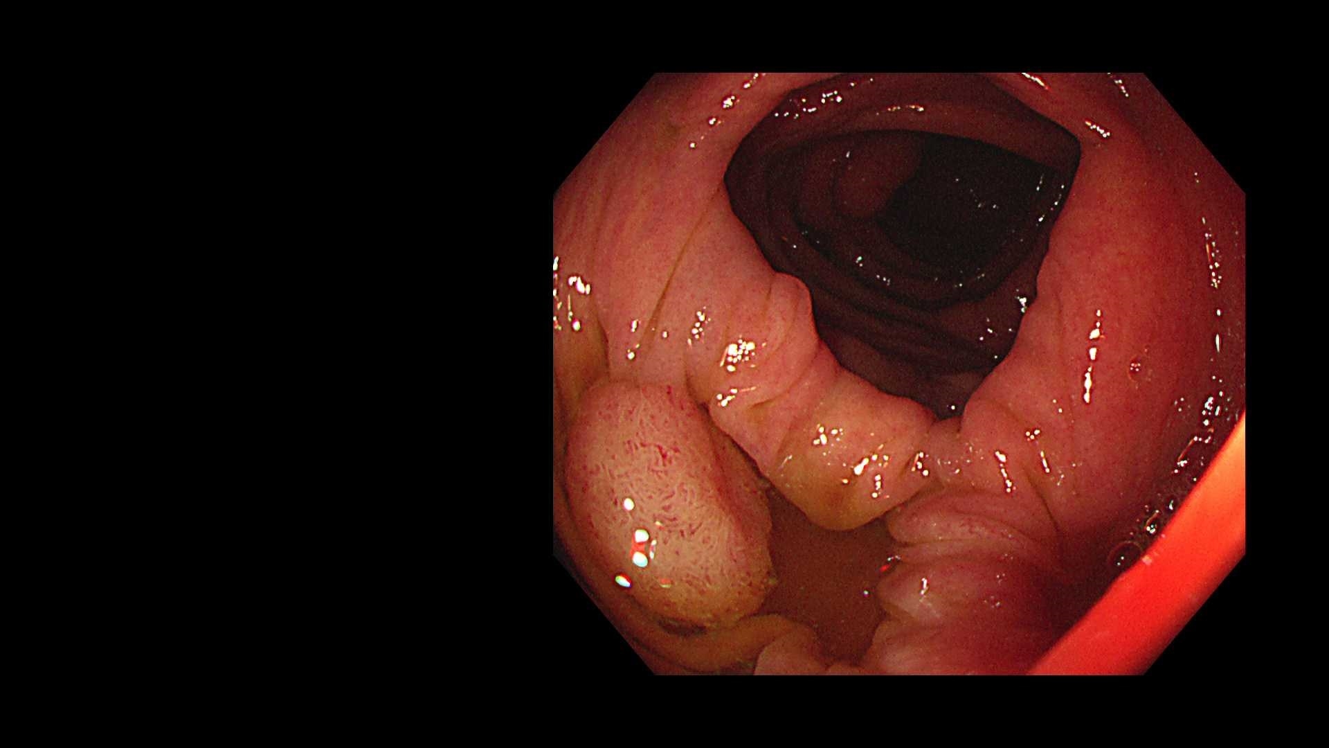 日帰り大腸ポリープ手術が受けられます